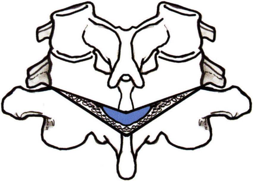 五、颈胸段结核性后凸椎弓与椎体间隙截骨矫形术